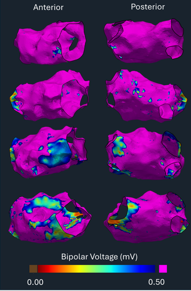 Combining clinical and left atrial electromechanical remodelling data: potential to improve atrial fibrillation ablation outcome prediction.