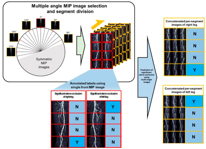 Deep Learning-Based Diagnosis of Femoropopliteal Artery Steno-Occlusion Using Maximum Intensity Projection Images of CT Angiography.