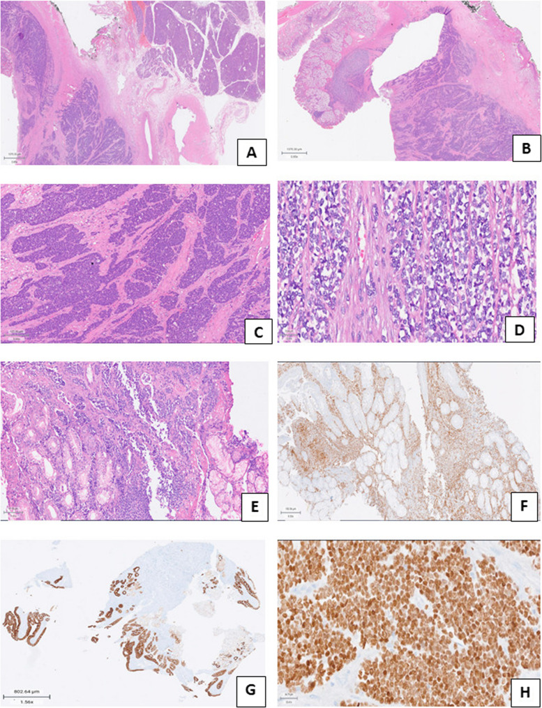 "Ewing's sarcoma of the duodenum: a rare gastrointestinal presentation": case report and review of literature.