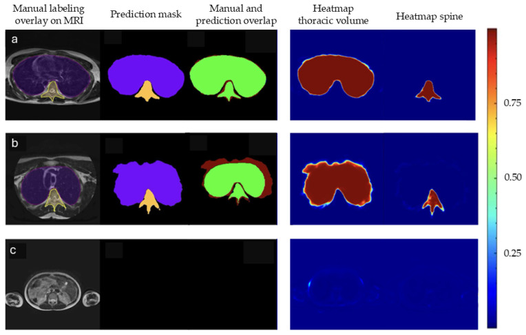 Quantification of Thoracic Volume and Spinal Length of Pediatric Scoliosis Patients on Chest MRI Using a 3D U-Net Segmentation.