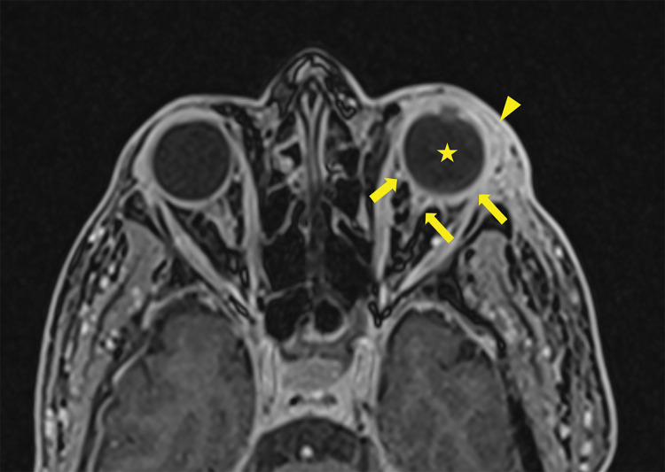 MRI Findings of Endogenous Endophthalmitis as a Complication of Pneumococcal Meningitis.