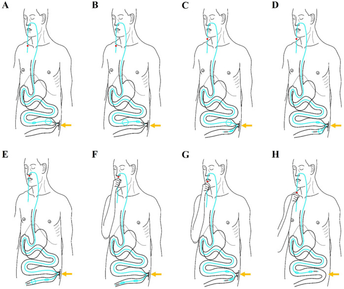 A novel approach of manual manipulation of the transnasal ileus tube for severe or recurrent benign adhesive small bowel obstruction.
