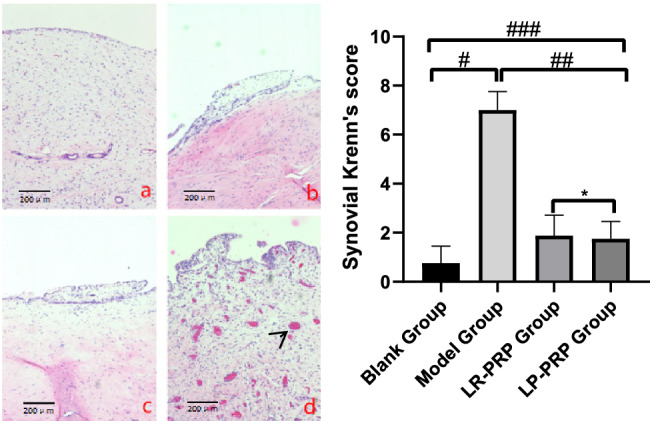 Comparison of the therapeutic efficacy of leukocyte-poor and leukocyte-rich platelet-rich plasma in rabbit knee osteoarthritis and the study of autophagy mechanism.