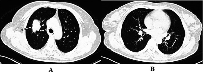 Analysis of the feasibility and health-economics value of simultaneous bilateral pulmonary surgery.