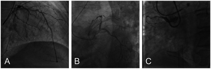 Extracorporeal membrane oxygenation-supported one-stop surgery for transcatheter aortic valve replacement and percutaneous coronary intervention in high-risk complex coronary artery and aortic valvular disease: a case report.