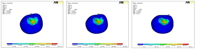 Biomechanical Analysis of Stress Distribution and Force Dynamics in Nobel Active Implants at Varying Angulations: A Finite Element Study.