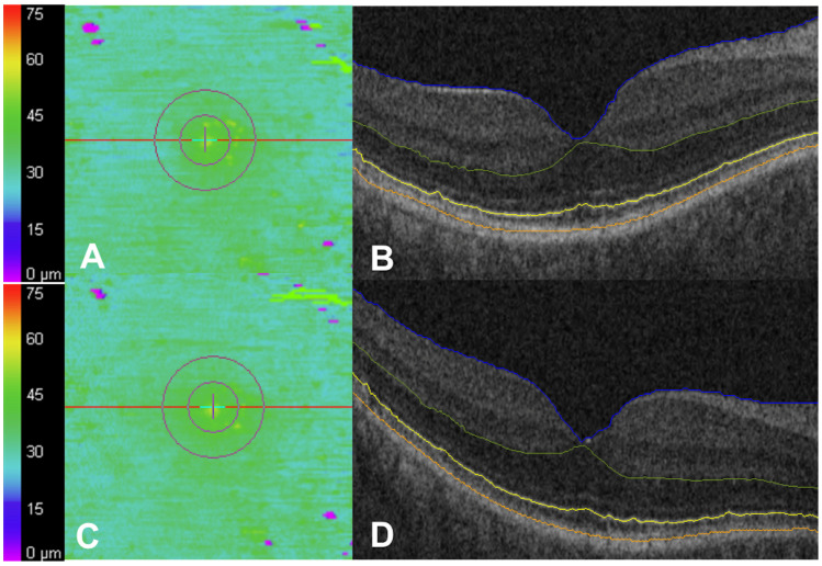 Longitudinal Ellipsoid Zone Dynamics During Hydroxychloroquine Use.