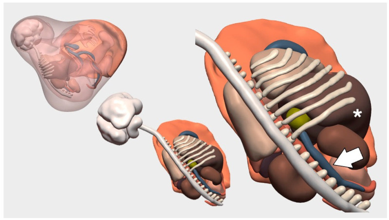 Clinical Impact of Patient-Specific 3D Models in Neonatal Surgery: A Case-Based Review of Applications and Future Directions.