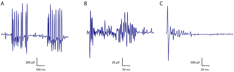 Neuromyotonia and CASPR2 Antibodies: Electrophysiological Clues to Disease Pathophysiology.