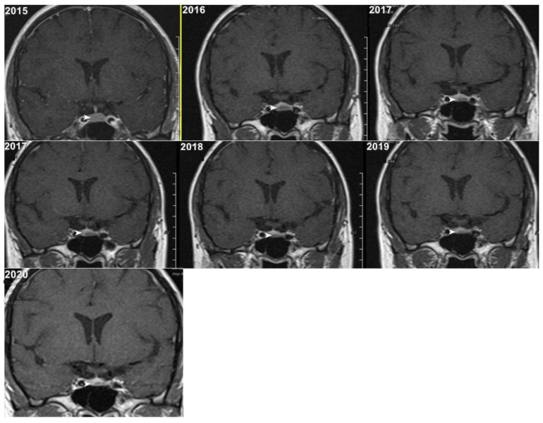 Rethinking MRI Protocols for Pituitary Microadenomas: Prioritizing Non-Contrast Imaging for Safe Follow-Up.
