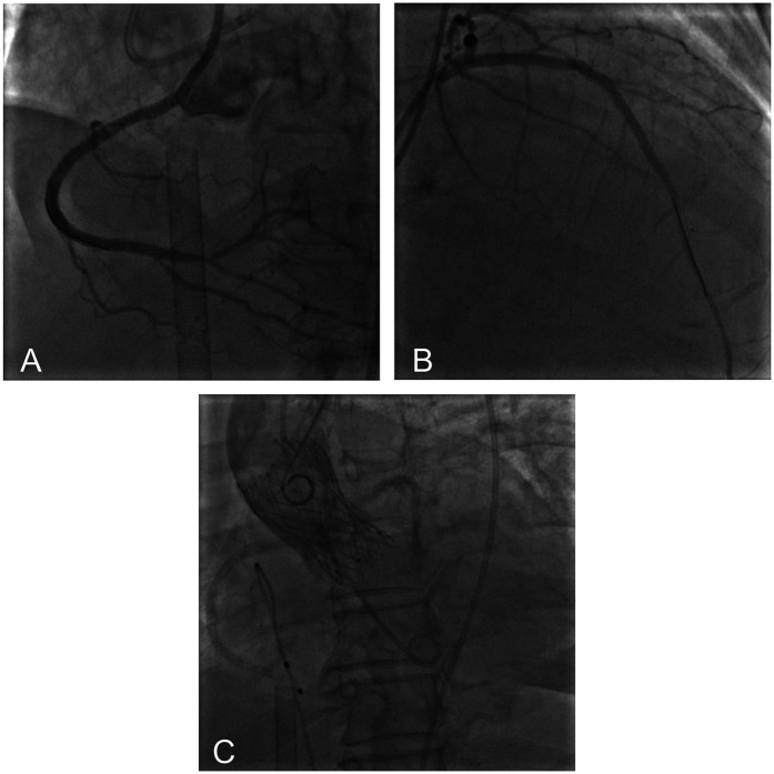 Extracorporeal membrane oxygenation-supported one-stop surgery for transcatheter aortic valve replacement and percutaneous coronary intervention in high-risk complex coronary artery and aortic valvular disease: a case report.