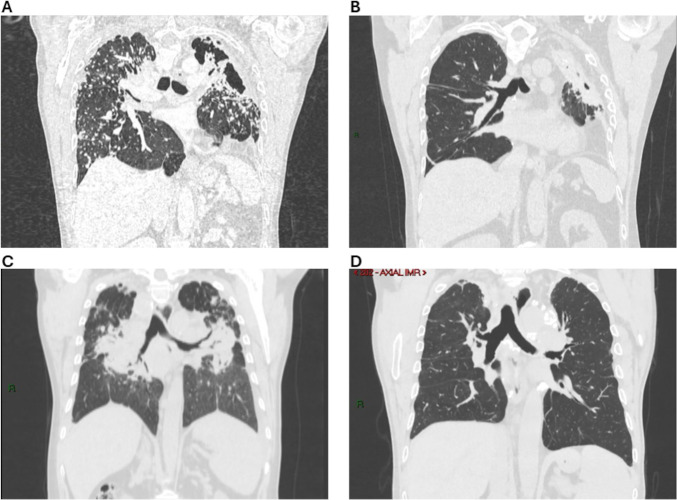 Single versus double lung transplantation outcomes in artificial stone silicosis: a single-centre retrospective cohort study.