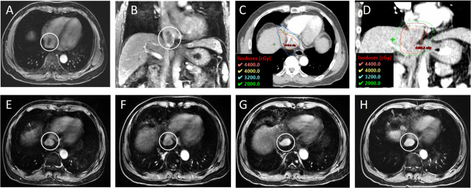 Efficacy and safety of stereotactic body radiotherapy for hepatocellular carcinoma with tumor thrombus in right atrium: a two-center retrospective review.