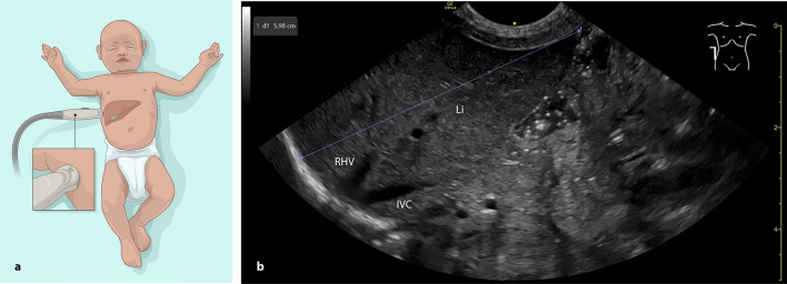 Turning the tide (and the probe)-sonographic liver measurement in the right lateral anterior axillary line is a reliable alternative to the standard frontal approach in term and preterm infants.