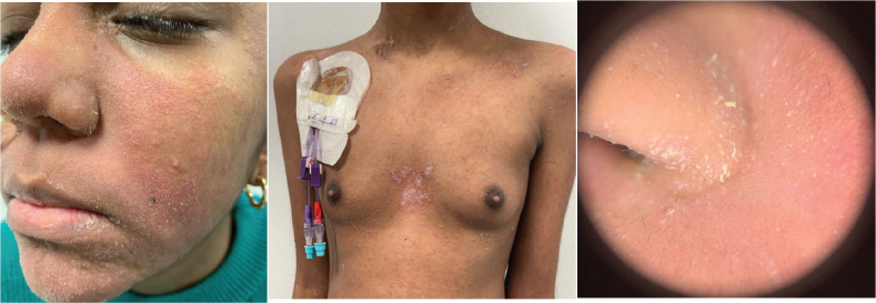 Cutaneous Graft-Versus-Host Disease Lichen Spinulosus-like: a New Form of Presentation of an Old Entity.