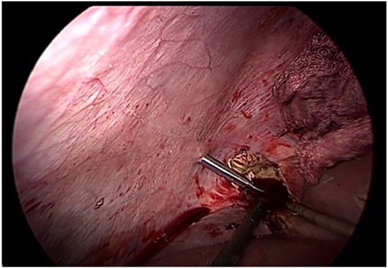 Laparoscopic management of a Gharbi type II hepatic hydatid cyst after failed pair.