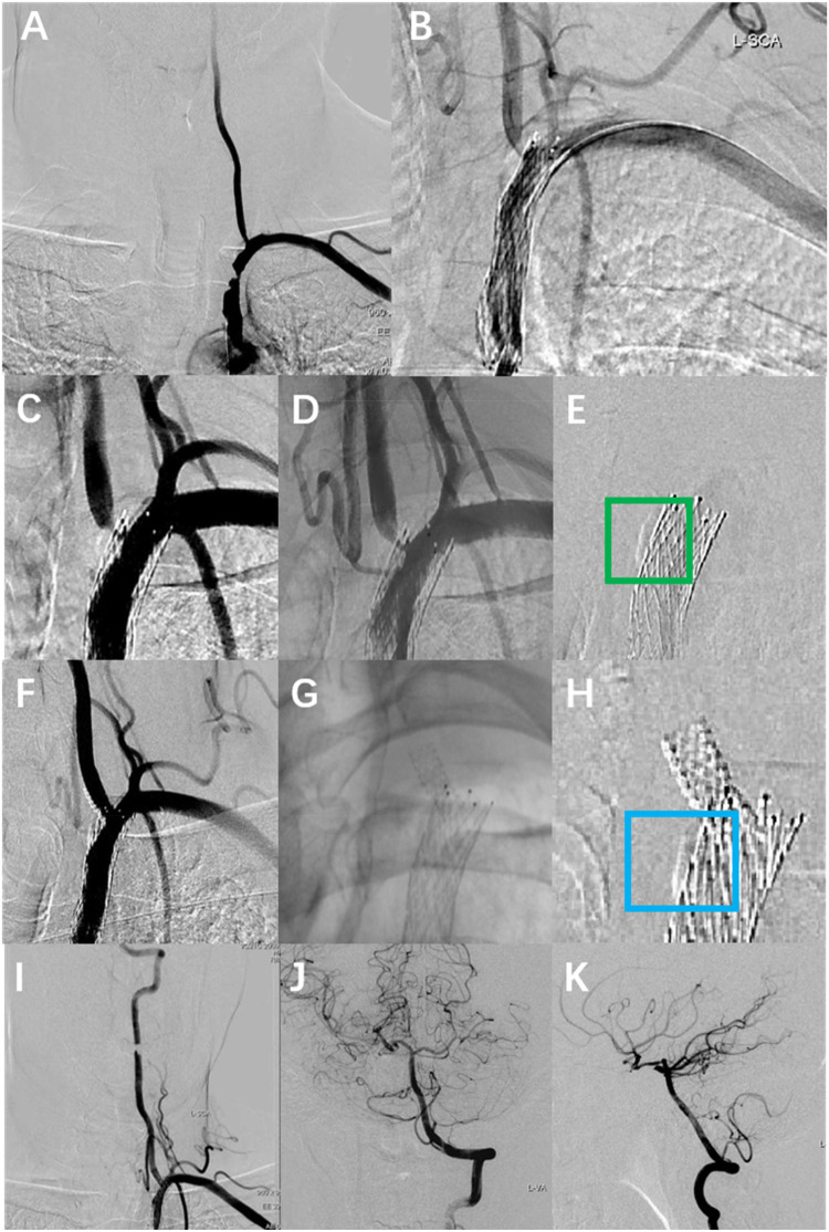 Conservative management of asymptomatic vertebral artery stent fracture with fragment embolisation to V3 segment: a case report.
