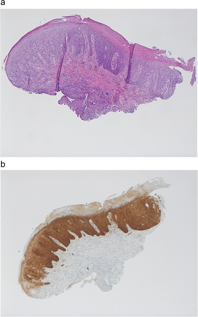 Late human immunodeficiency virus presenting as necrotizing anal ulceration due to cytomegalovirus.