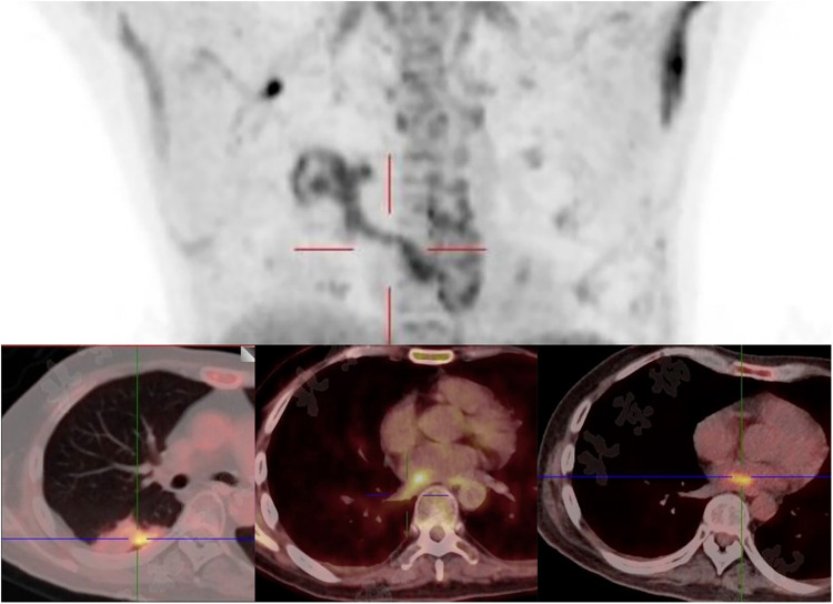 "Mushroom in the heart": a <i>Volvariella volvacea</i> infective endocarditis case report.