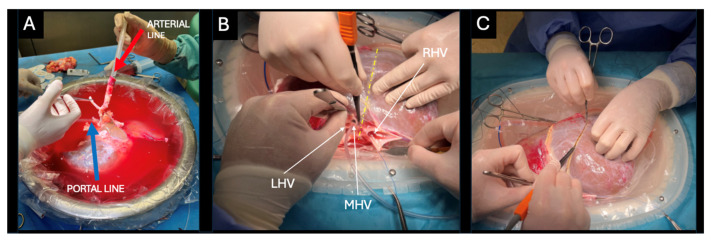 Ex-Situ Dual Hypothermic Oxygenated Machine Perfusion in Full-Left-Full-Right Split Liver Transplantation for Two Adult Recipients.