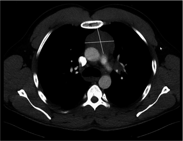 Observation of PICALM::MLLT10-rearrangement and coincidental EZH2 mutations in a patient with acute myeloid leukemia: A case report and review of the literature.