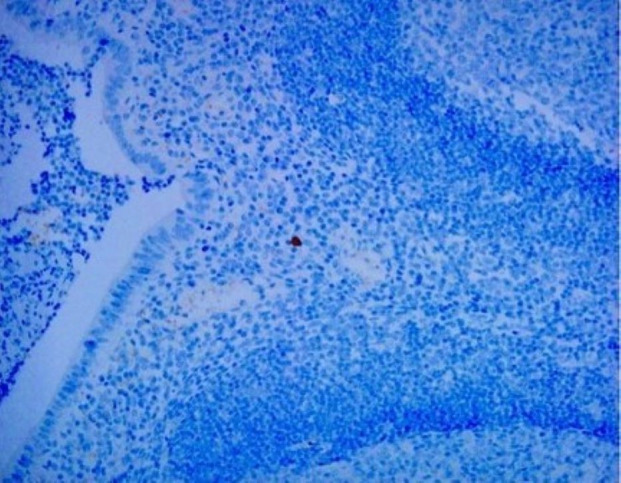 Relationship between adenovirus infection and intussusception via pathological evidence confirms.