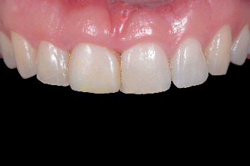 Fully Guided Implant Placement and Immediate Provisionalization in the Maxillary Aesthetic Zone Using Prefabricated Restorations.