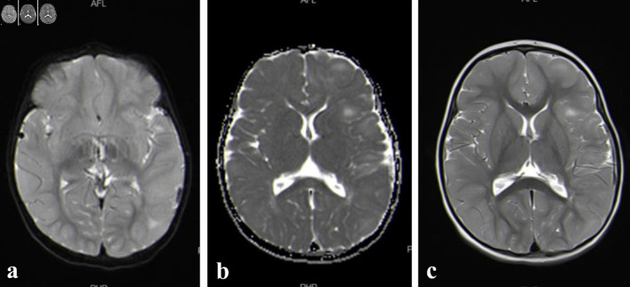 Renal Cell Carcinoma in a Girl With Tuberous Sclerosis Due to a New Mutation.