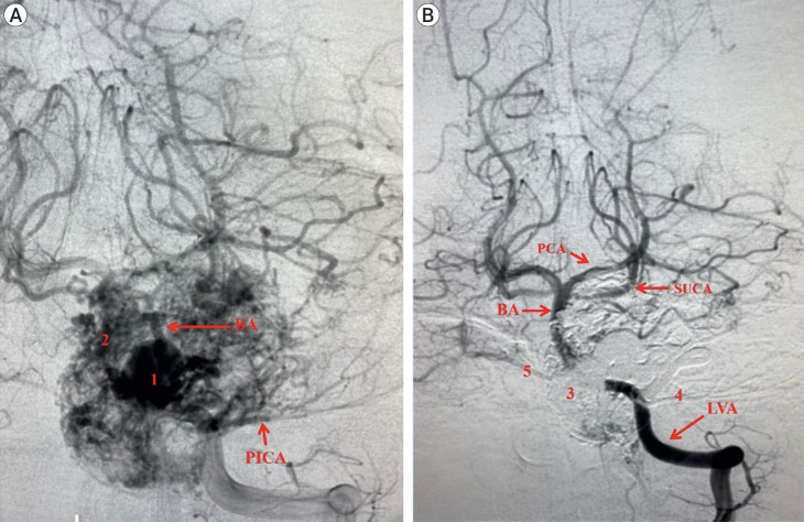 Preoperative embolization of brain, head, and neck tumors: Single center experience and literature review.