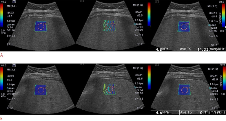 Effect of breath control on hepatic shear wave elasticity and dispersion in pediatric patients.