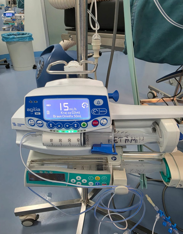 Ketofol (Ketamine-Propofol) in Pediatric Awake Neurosurgery: An Anesthetic Perspective.