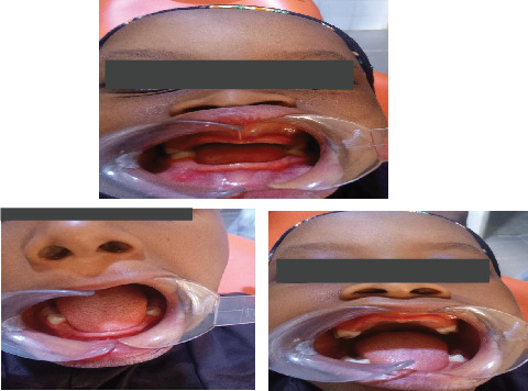 Oligodontia Management in a Resource-Limited Setting: Two Case Reports and Review of Literature.