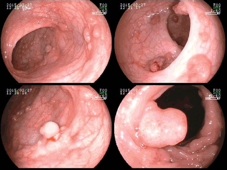 The polyp puzzle: multiple lesions, one diagnosis.