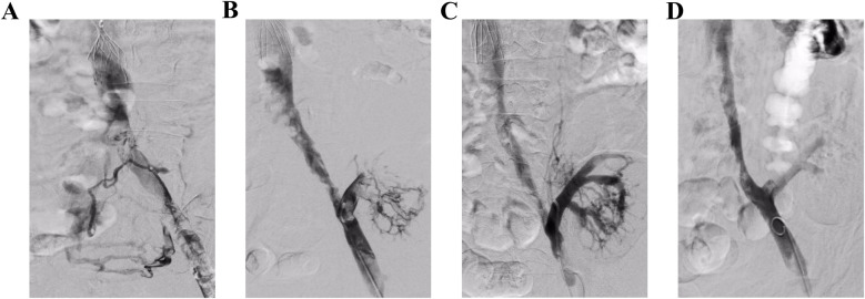 Case Report: Application of the AngioJet thrombectomy system in acute lower extremity deep vein thrombosis complicated by transplanted renal vein thrombosis (report of two cases).