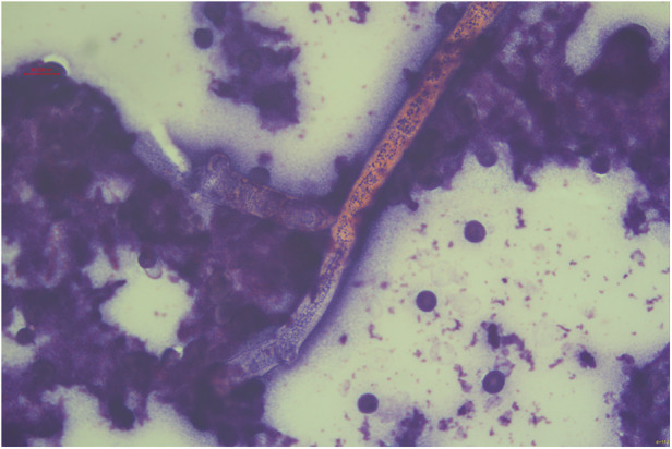 "Mushroom in the heart": a <i>Volvariella volvacea</i> infective endocarditis case report.