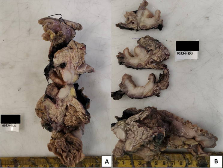 "Ewing's sarcoma of the duodenum: a rare gastrointestinal presentation": case report and review of literature.