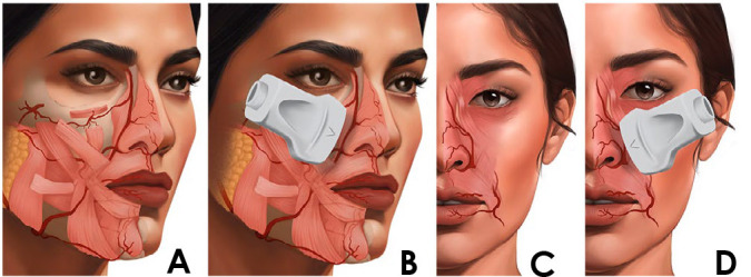 Depth and hemodynamics of the angular artery in the pyriform space: A cross-sectional study with Doppler ultrasonography.