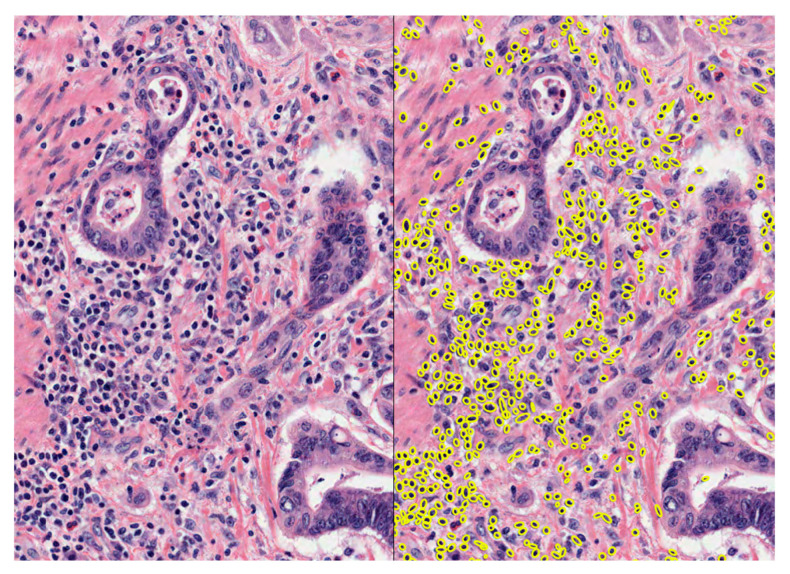 Tumour-Infiltrating Lymphocytes, Tumour Cell Density, and Response to Neoadjuvant Short-Course Radiotherapy in Rectal Cancer: A Translational Sub-Study from the MRC CR07 Clinical Trial.