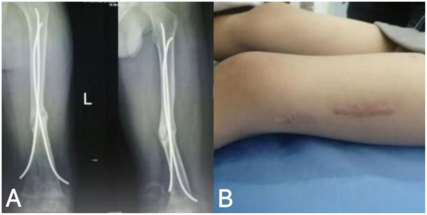Radial extracorporeal shock wave promotes the treatment of non-union of femoral shaft fractures in children: a case report.
