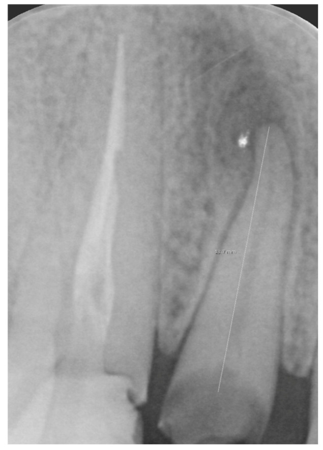 Orthodontic Extrusion in Daily Clinical Practice: Management of Fractured or Damaged Anterior Teeth.