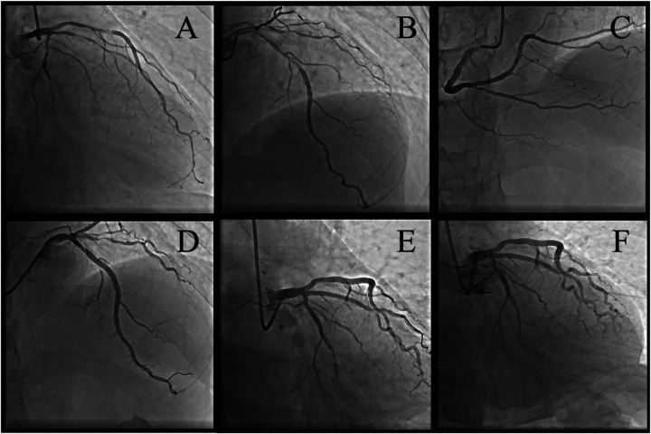 Case Report: Coronary plaque rupture following glucocorticoid tapering in a high-risk CAD patient with immune nephritis: mechanistic insights and clinical implications.
