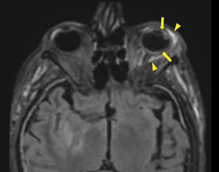 MRI Findings of Endogenous Endophthalmitis as a Complication of Pneumococcal Meningitis.