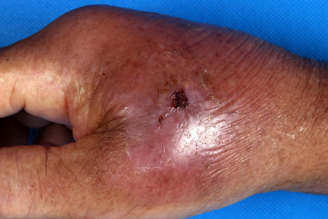 Non-Tuberculous Mycobacterial Infections of the Skin and Soft Tissue in a Chinese Population: A Retrospective Analysis of 15 Cases.