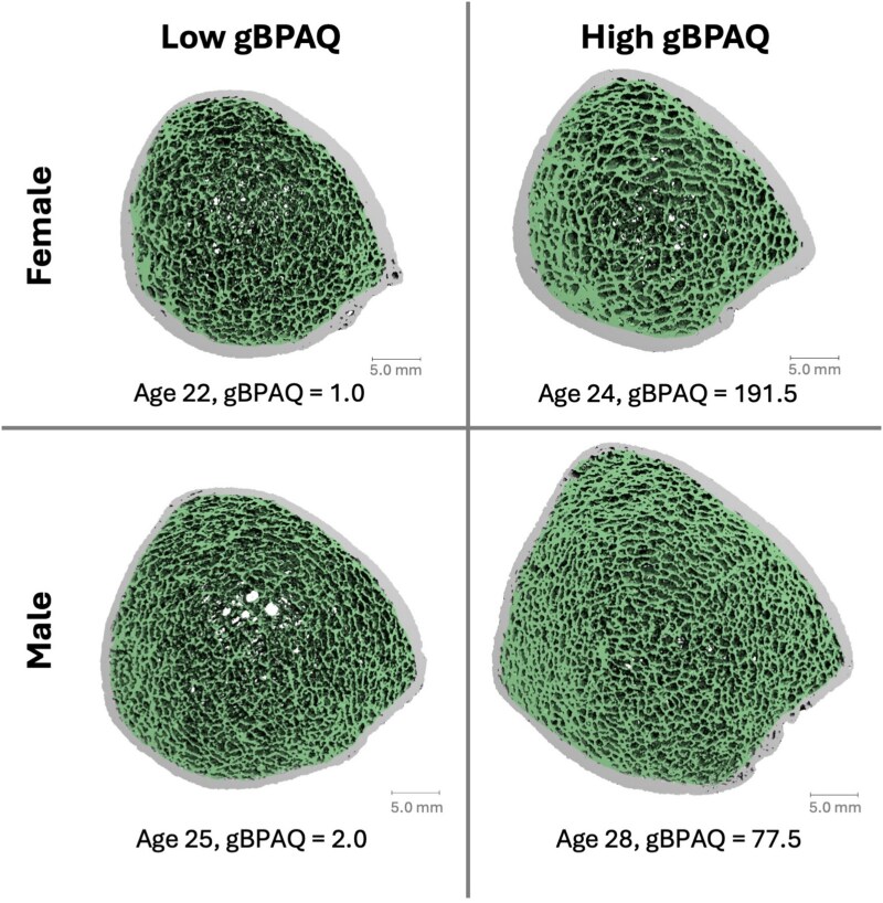 The association between physical activity during growth and bone microarchitecture at peak bone mass.