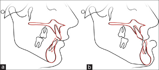 Combined treatment approach: A review of using clear aligners in orthognathic surgery procedures.