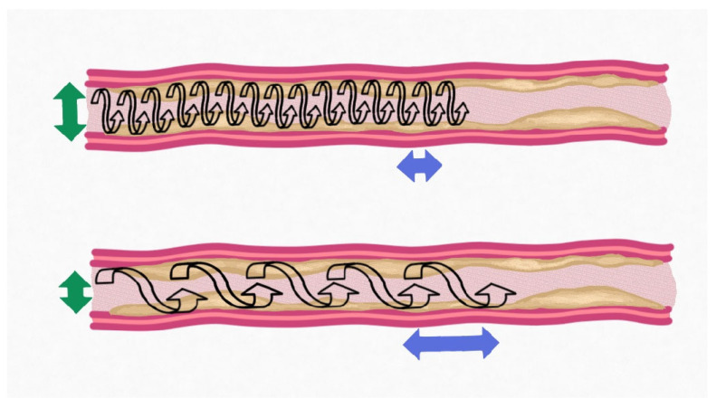 The Role of Orbital Atherectomy for Complex Coronary Calcium Modification: Has It Been Eclipsed?