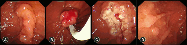 The polyp puzzle: multiple lesions, one diagnosis.