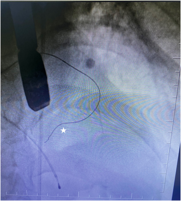 Contrast echocardiography with a physiological contrast agent for alcohol septal ablation.
