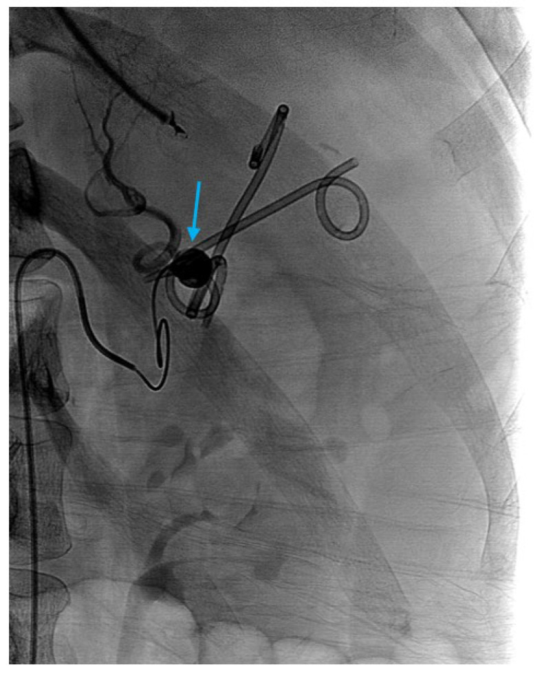 Interventional Management of Acute Pancreatitis and Its Complications.