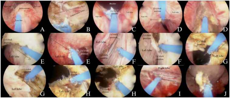 Learning curve analysis of transurethral thulium fiber laser enucleation of the prostate with preserving urethral Mucosa at the prostatic apex.